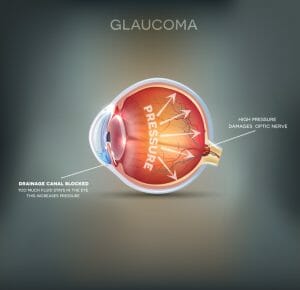 Glaucoma Diagram