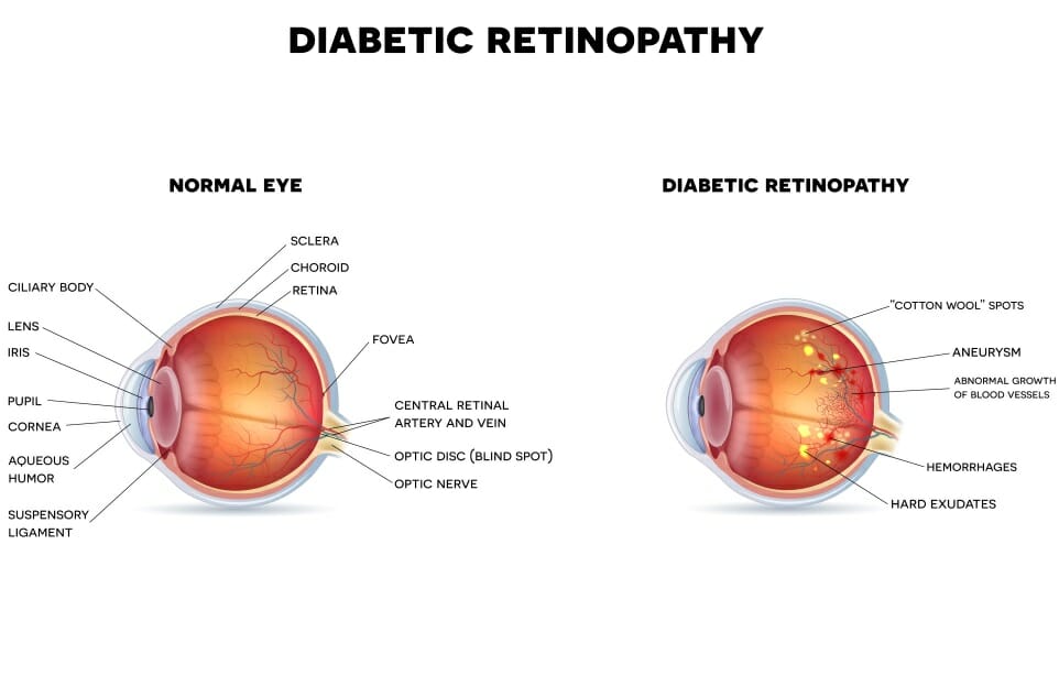  Diabetic Retinopathy Diagram