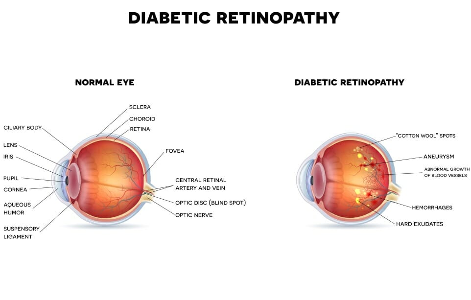 Diabetic Retinopathy Philadelphia 