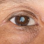 What is a Cataract? Cataract Definition