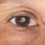  Cataract Philadelphia